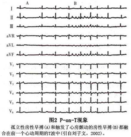 (4) 诱发心房颤动的房性期前收缩常与孤立性房性期前收缩的形态相似, 偶有形态迥然不同的孤立性房性期前收缩, 可能属于旁观者, 与心房颤动的诱发无关 (5) 单发的房性期前收缩以及触发心房颤动的第一个异位 P 波, 常重叠在前一个 QRS 波后的 T 波中, 形成 P-on-T 现象 ( 图 2) (6)