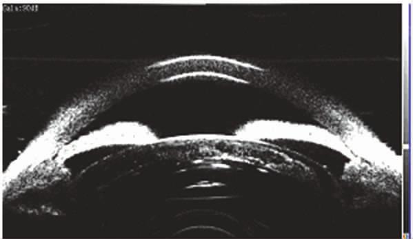 )$/ /!1? 检查对比研究合并白内障的闭角型青光眼患者手术前后影像学参数的改变发现 白内障超乳术后晶状体虹膜隔后移 前房明显加深 睫状突位置明显 后移 房角宽度较术前明显增加 研究表明 白内障摘除联合 2< 植入是以不足. )) 厚的 2< 替代约.