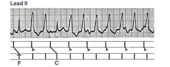 心室夺获 : 室速发作时, 少数心房激动下传心室并完全控制心室活 动 ; 即 QRS 波群形态正常 其前有相关 P 波