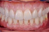Nexco 来重建牙龈组织是一种有效的修复方法 与全瓷材料不同, 复合树脂更容易处理, 能获得特别的美学效果 ( 图 13) 这种材料很轻, 这是另一个优点 全瓷修复体 ( 二氧化锆支架, 分层瓷, 牙龈瓷 )