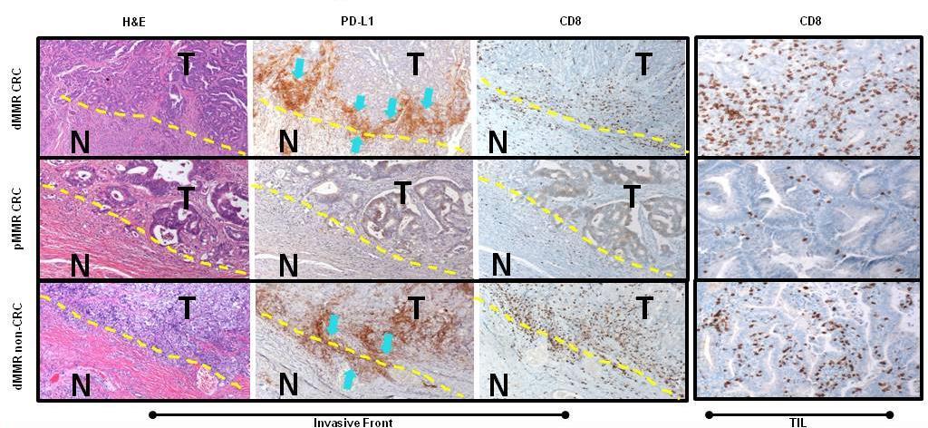 高突变频率 --- 高 TIL 细胞浸润 --- 高 PD-L1 表达理论在肠癌中证实