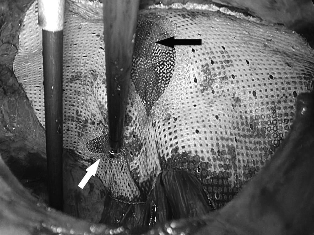 3 Partial incision dashed arrow of the arcuate line arrow heads on its lateral edge to ensure the adequate lateral dissection necessary for mesh placement.