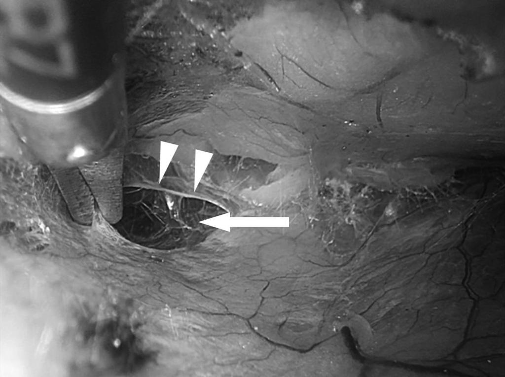 2 Opening of the superficial preperitoneal fascia arrow heads to enter the preperitoneal space arrow. Fig.
