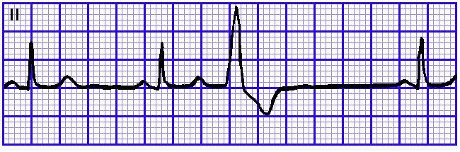 三 室性室性早搏 (1) 提前出现一个增宽 变形的 QRS-T 波群 ; (2)QRS 时限 >0.