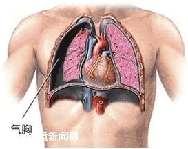 肺泡扩张受限引起的肺泡通气不足 1