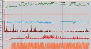 0 10 20 5 LF LF LF [1] Tsugiyoshi, MD : Central Sympathetic Inhibition Augments Sleep-related Ultradian