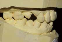 Adeqate remaining bone Possibilities to control etiologic factors Maintainable dentition
