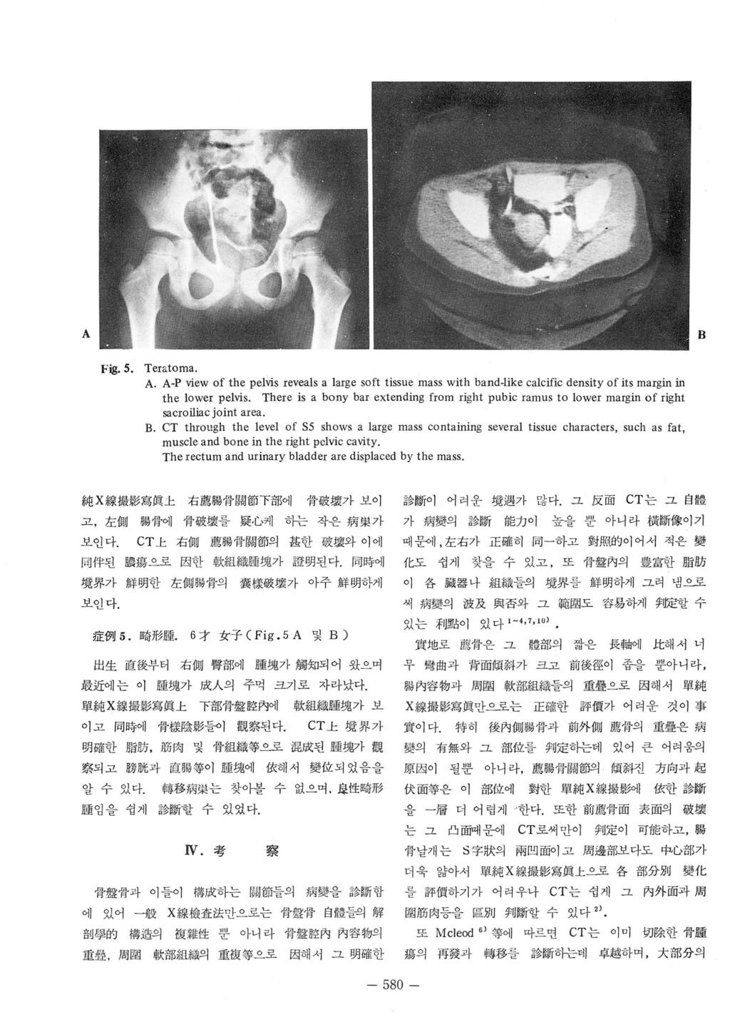 _ 얹 f 엉 ------ 륙듀도 Fig. 5. Teratoma.. -P view of the pelvis reveals a large soft tissue mass with band-like calcific density of its margin in the lower pelvis.