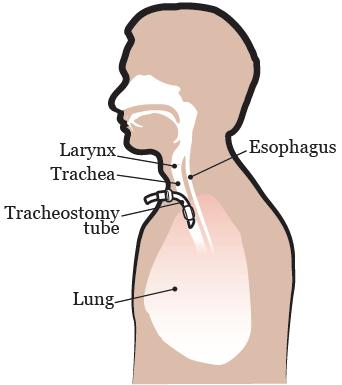 病人和職業教育气管造口术后护理 本信息将帮助您进行气管造口术后护理 关于气管结构 气管是呼吸系统的一部分 它的长度约为 4½ 英寸 (11 厘米 ), 位于颈部前方