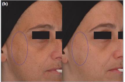 Reduction in the appearance of facial hyperpigmentation after use of moisturizers with a combination of