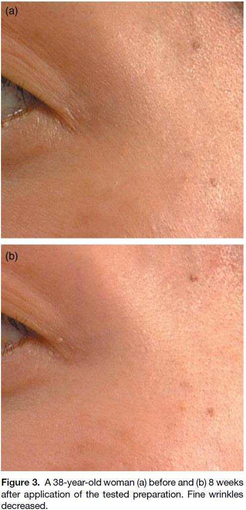 Evaluation of anti-wrinkle effects of a novel