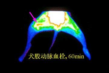 45~60 min 的局部显像图上出现清晰的条索状放射性浓聚影, 长约 3 cm, 宽 1 cm( 如图 6 所示 ),120 min 血栓影变模糊, 两者 T/B 比值分别为 1.47 和 1.