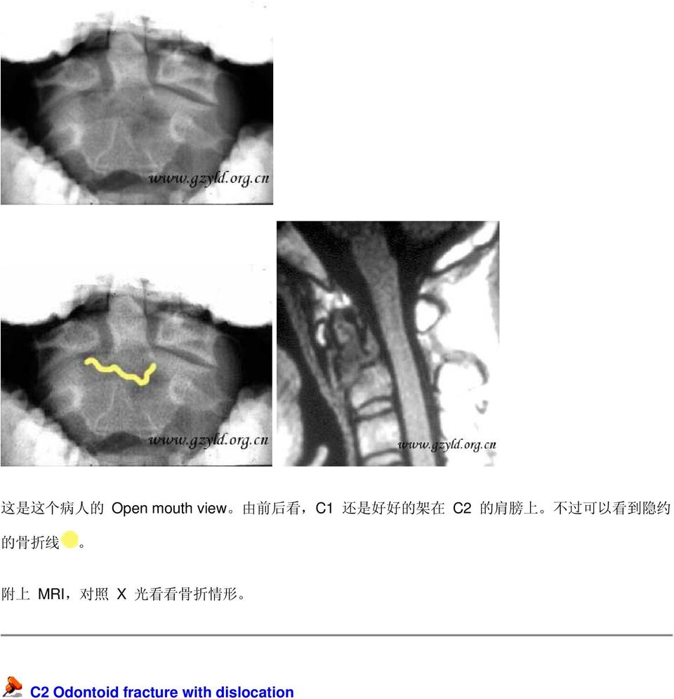 看 到 隐 约 的 骨 折 线 附 上 MRI, 对 照 X 光 看 看 骨