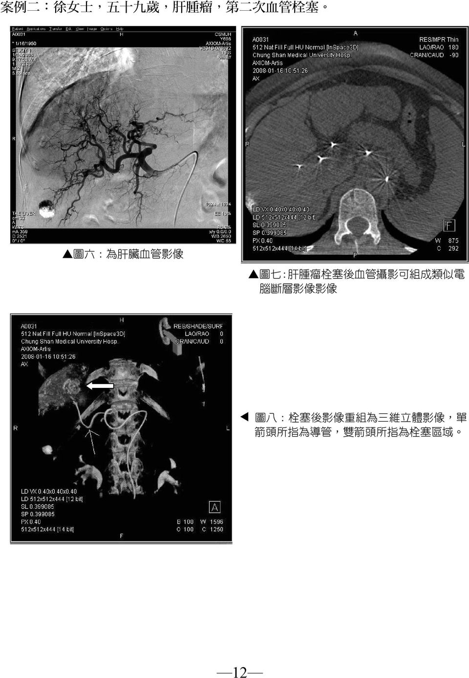 肝腫瘤栓塞後血管攝影可組成類似電 腦斷層影像影像 W
