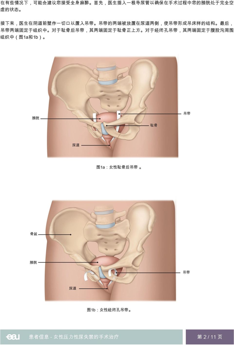 后, 吊 带 两 端 固 定 于 组 织 中 对 于 耻 骨 后 吊 带, 其 两 端 固 定 于 耻 骨 正 上 方 对 于 经 闭 孔 吊 带, 其 两 端 固 定 于 腹 股 沟 周 围