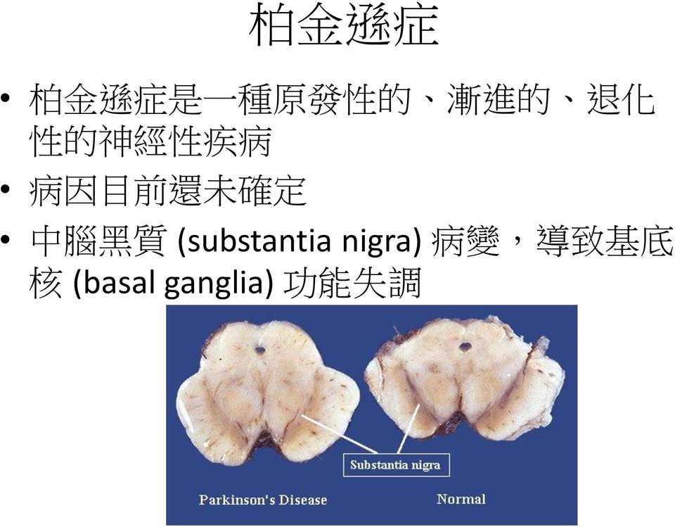 定 中 腦 黑 質 (substantia nigra) 病 變,
