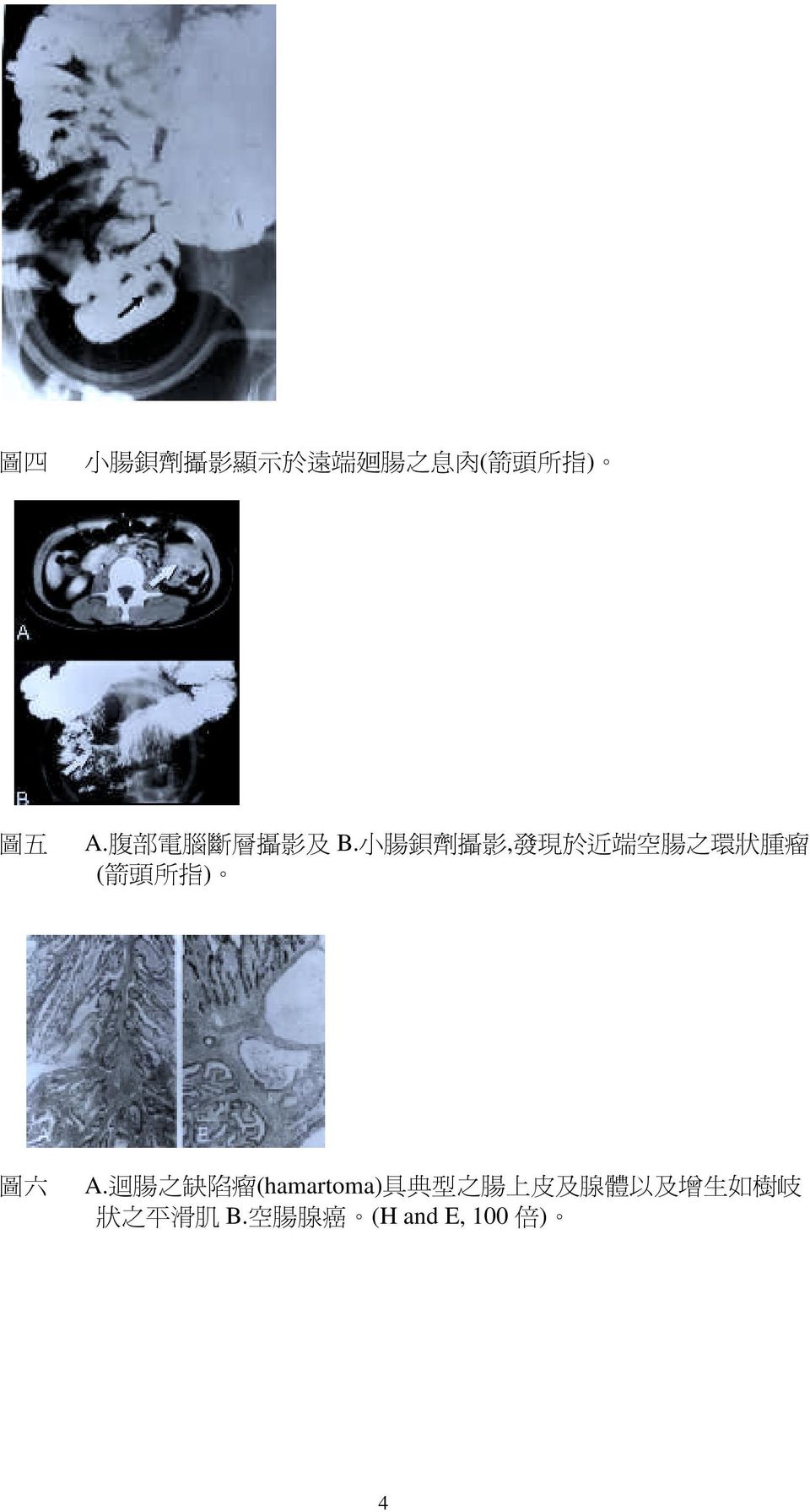 小 腸 鋇 劑 攝 影, 發 現 於 近 端 空 腸 之 環 狀 腫 瘤 ( 箭 頭 所 指 ) 圖 六 A.