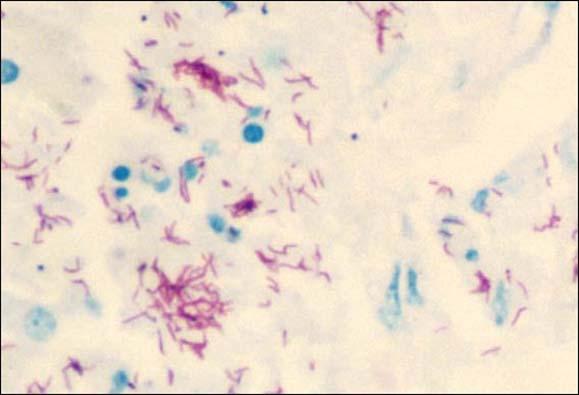 发现与形态 结核病的病原菌的发现 : 德国细菌学家