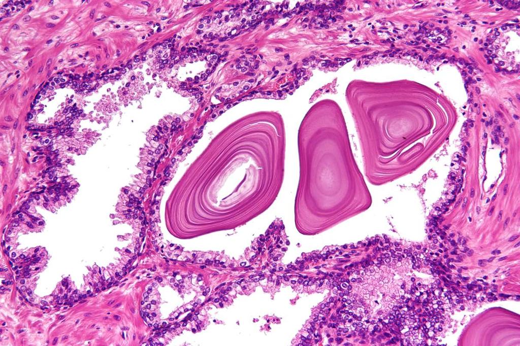 The tubuloalveolar glands of the prostate are formed by a cuboidal or a columnar