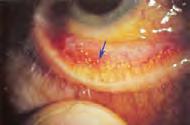 Conjunctival concretion جوش ملتحمهای Keratoconjunctivitis Sicca: KCS or Dry Eye Syndrome: DES کراتوکونژکتیویت سیکا اصطاحی مترادف با سندرم )نشانگان( چشم خشک که میتواند به دلیل کمبود جزء آبکی