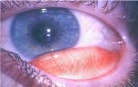 4 چشم بروز میکند بخصوص وقتی که یک عامل حساسیتزای مشخص وارد چشم شود.