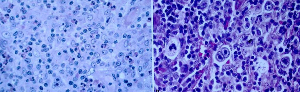 经典霍奇金淋巴瘤 混合细胞型 Mixed cellularity 20%-25% 1.