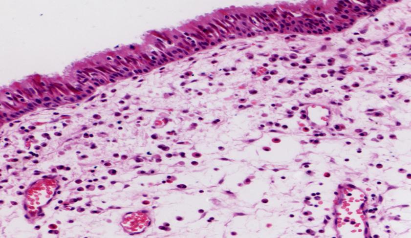 炎症的基本病理变化 - 增生 实质细胞和间质细胞的增生 实质细胞增生 - 黏膜上皮细胞