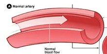 病因 1. 子宫肌层有异常滋养细胞侵入 2. 免疫异常 3.