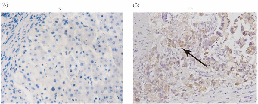426 31 Fig 3 Detection of FOXQ1 protein expression was used by immunohistochemistry in paracarcinoma tissues and HCC tissues Paraffin-embedded sections were deparaffinized
