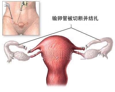 ( 五 ) 输卵管绝育术 适应证 要求接受绝育手术且无禁忌证者 ; 患有严重全身疾病不宜妊娠者 手术时间