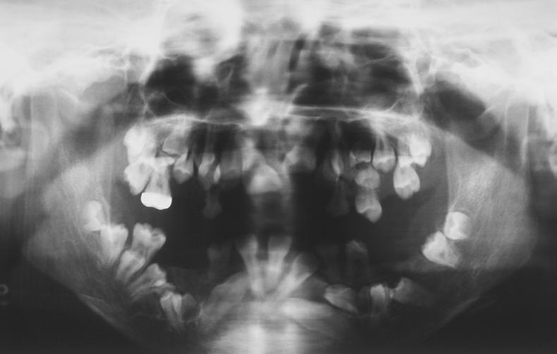 6 F-H 上顎以兩側第一大臼齒作為支柱牙 並 下顎前齒區則作 放置亞當斯牙鈎 dams clasp 表.