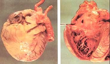 慢性肺源性心脏病
