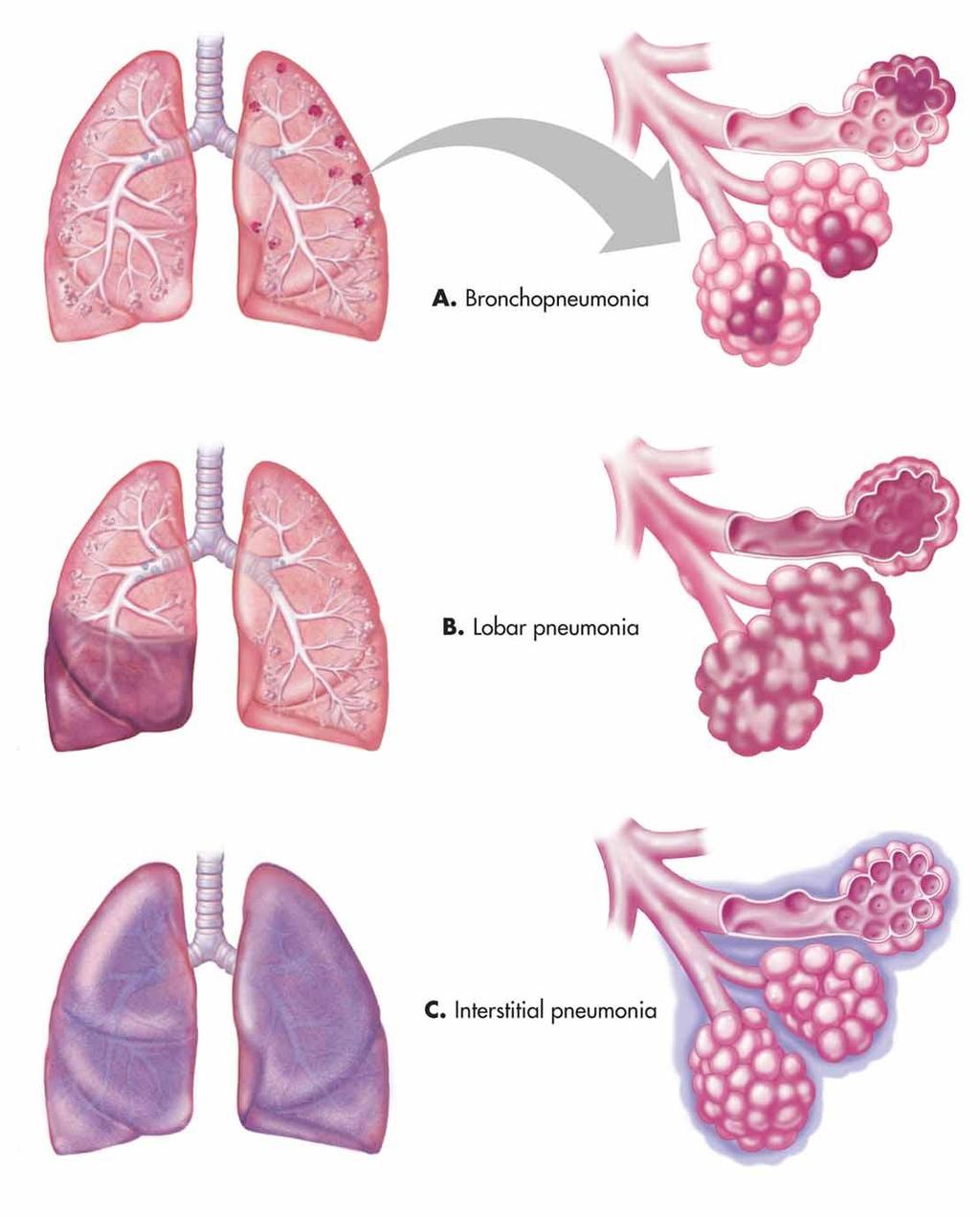 Pneumonia ( 肺炎 ) Self Assesment 灰色肝样变 Gray hepatizatin 肺肉质变