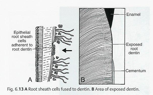 3. 牙根牙本質缺乏 cementum 的覆蓋 l 如果上皮根鞘的上皮在適當的時間 (proper time) 沒有發生斷裂,