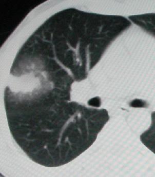 肺炎性假瘤 CT