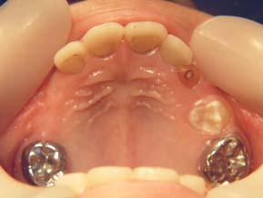 圖 3. 全口重建後的口內照片 上顎兩側的恆牙第一大臼齒使用不鏽鋼成型牙冠, 正中與側門齒使用複合樹脂填補,