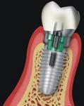 95 什麼是 人工植牙 林玫吟 曾春祺 人工植牙 是將無菌處理過 與人體組織能結合良好的鈦金屬牙根 以外科手術植入齒槽骨中