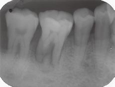 位置的口腔潰瘍也可能感覺像牙齦腫 因此需請醫師作診斷 如果為牙周問題 通常不會只有一顆牙有問題