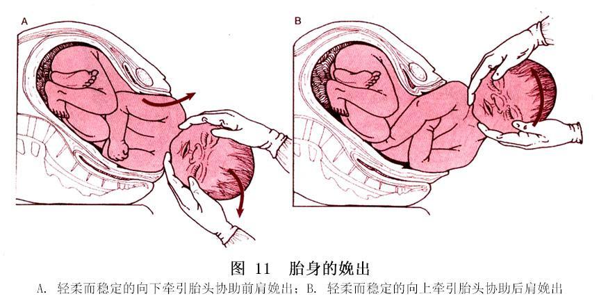胎体分娩时重要的是合适定位 羊水 血 涂剂有助于分娩润滑 固定后部或左手于胎儿纵位, 随后娩出胎体其他部分 胎儿娩出时用左手抓住胎儿踝部,