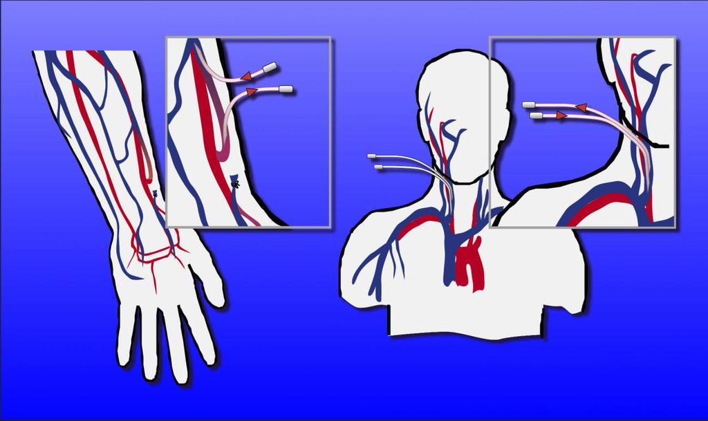 血管通路 Vascular Access 動靜脈廔管 雙腔導管 內頸靜脈 將動脈與靜脈接起來 主動脈 動靜脈廔管術
