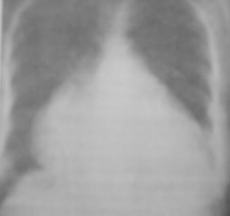 异常 X 线影像 ---- 心脏增大 普大型 PA: