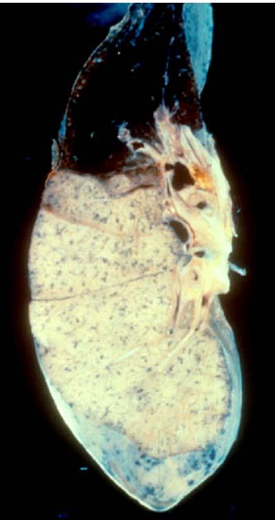 Lobar Pneumonia 大叶性肺炎 Grey hepatization (consolidation) 灰色肝样变期