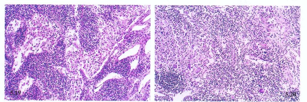 反应性窦组织细胞增生 (Reactive sinus histiocytosis) 左 : 腹股沟淋巴结 淋巴窦扩张, 充满增生的组织细胞 窦性组织细胞增生性巨淋巴结