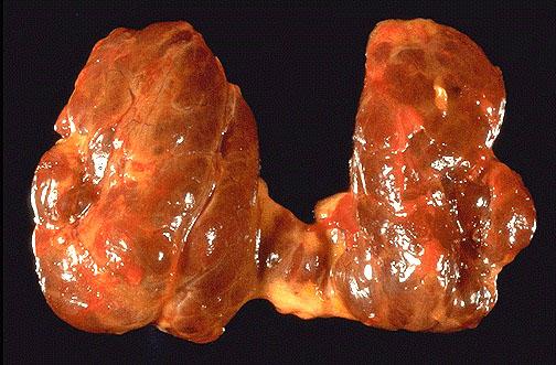 This diffusely enlarged thyroid gland is