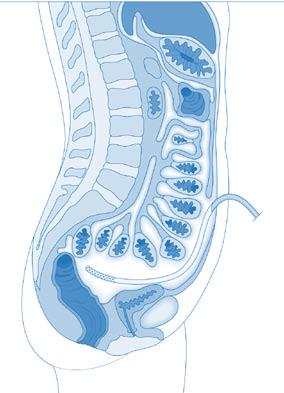 8 連接腹腔的方法 : 會將一條柔軟無刺激性的矽膠導管植入腹部內, 通常在肚臍的底下或一旁, 透析液都是經過這條特製的導管注入腹腔或從腹腔中排走 它會一直留在腹腔內,