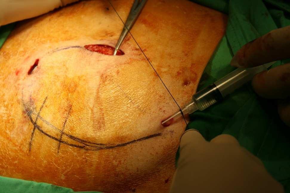 suture line.