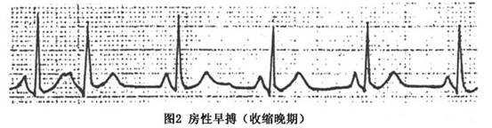 12s (3)QRS 波群的形态 时限和基本窦性心律相同 (4) 有不完全性代偿间歇 ( 图 1,2) 2.