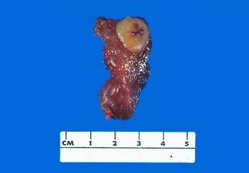 201106 ZR 三 甲状腺肿瘤 ( 一 ) 甲状腺腺瘤 1. 胚胎型腺瘤 2.