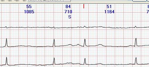 一 房性早搏 (1) 提前出现的异常 P 波 ; (2) 早搏与窦性下传的 QRS 波群相似 (