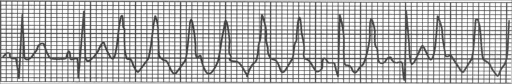 房室分离, 心室夺获, 室性融合波房室分离 : 心房激动波与宽大畸形的 QRS 波群之间无固定关系 心室夺获 : 室速发作时, 少数心房激动下传心室并完全控制心室活动 ; 即 QRS 波群形态正常